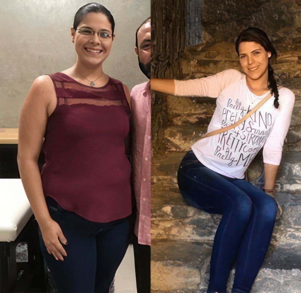 Emma before and after bariatric surgery