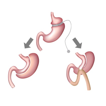 Bariatric revision surgery options