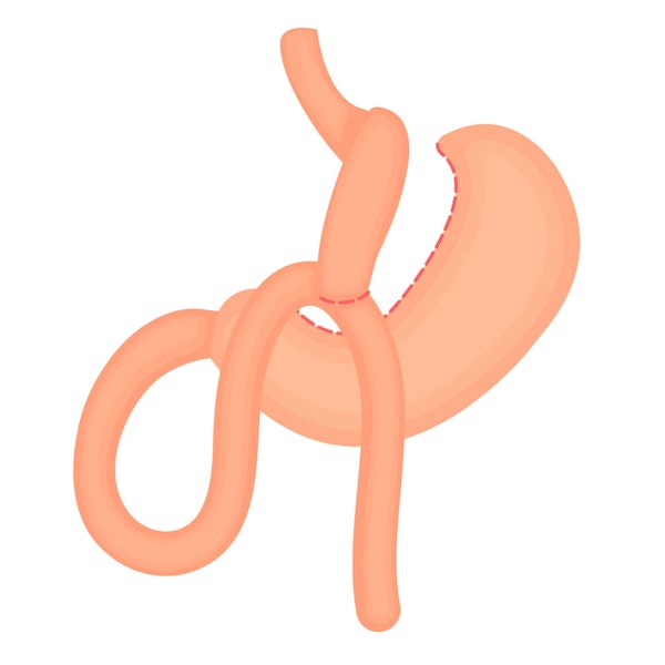 mini gastric bypass illustration