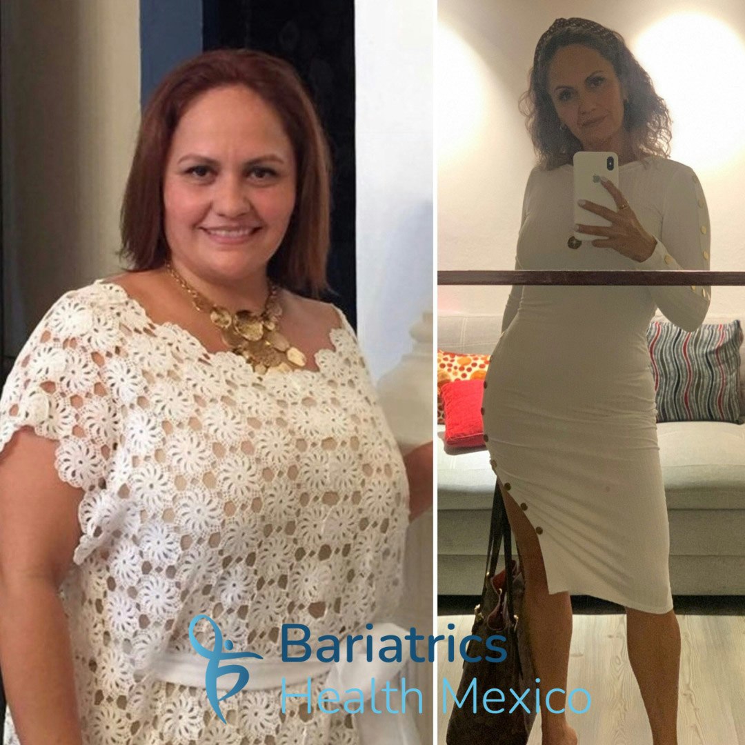 Before and after bariatric surgery
