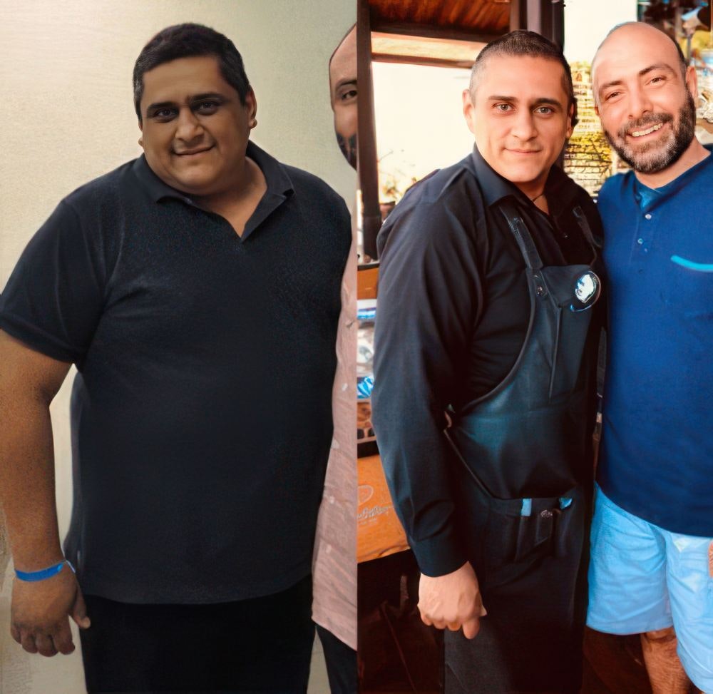 Fernando before and after bariatric surgery