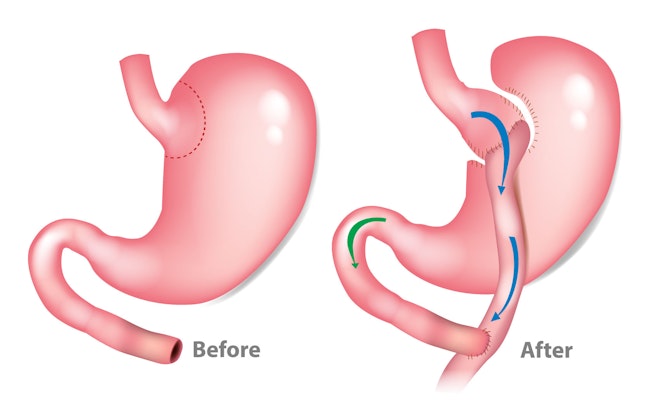 before and after gastric bypass