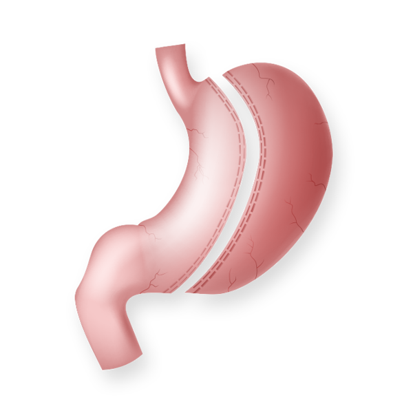 Illustration of gastric sleeve surgery