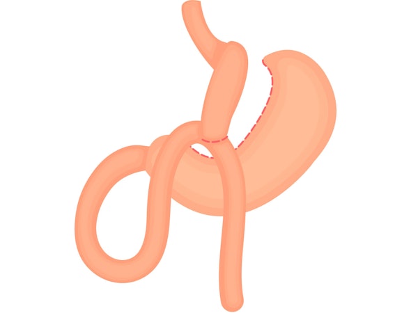 Mini gastric bypass procedure illustration